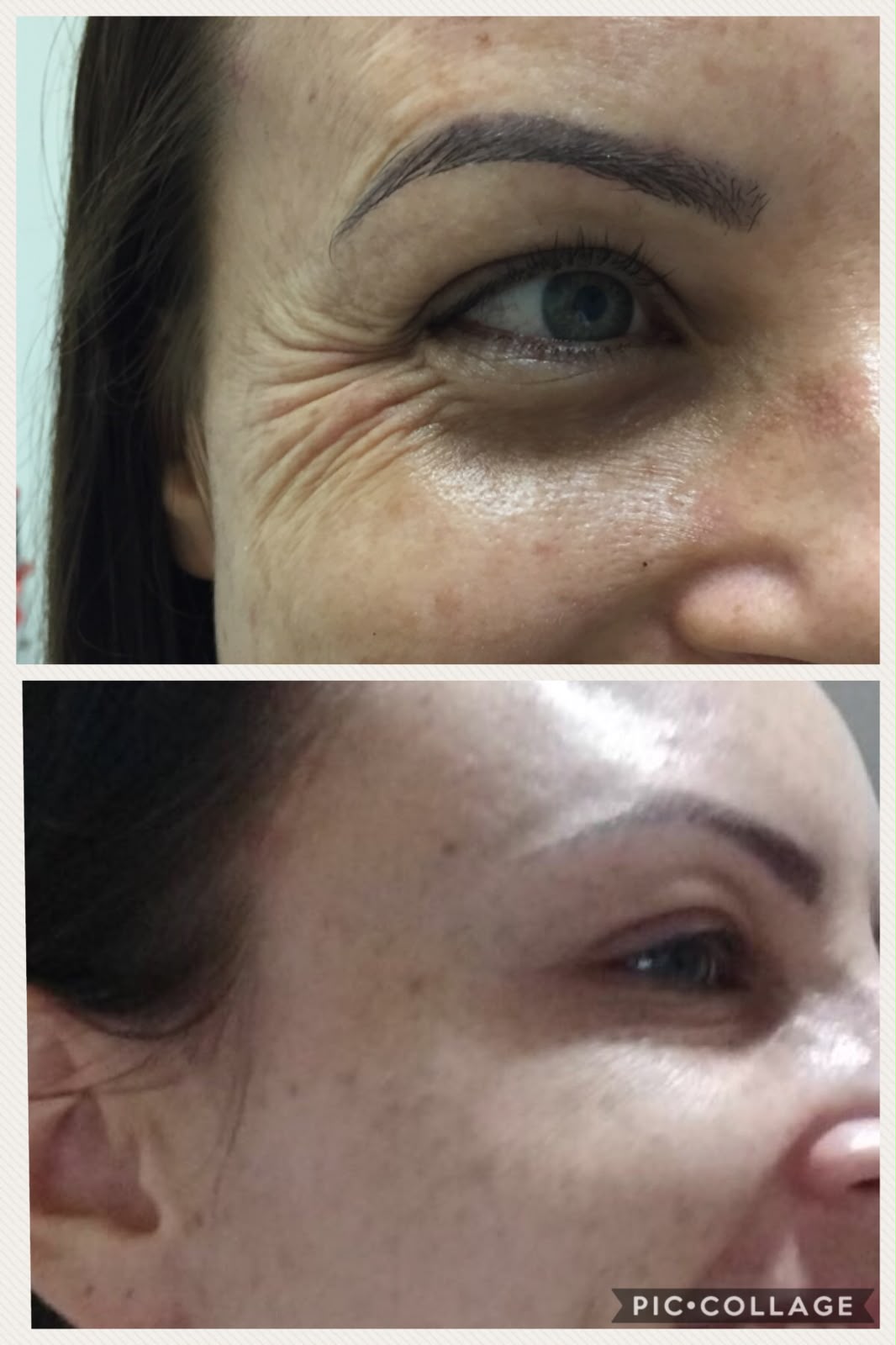 Antes e depois do botox, foto 2