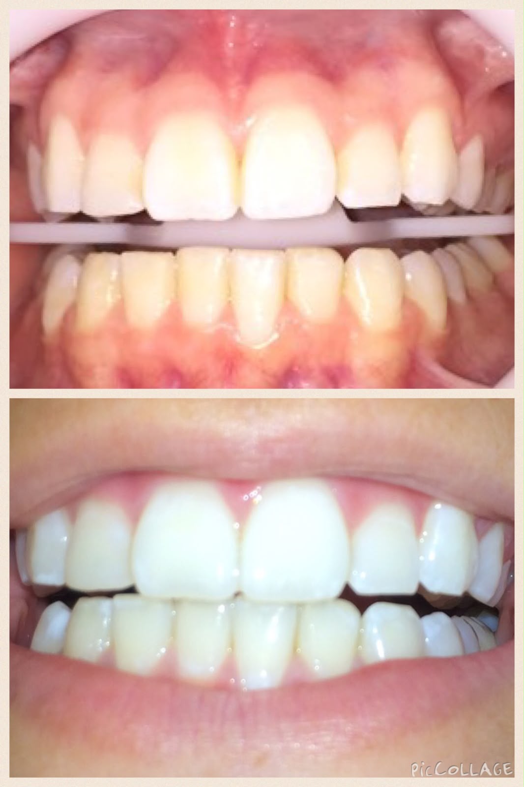 Antes e depois do clareamento, foto 1