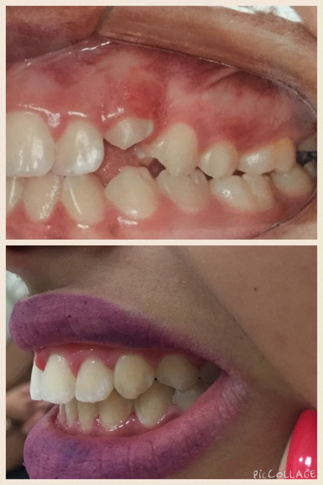 Antes e depois da ortodontia, foto 2